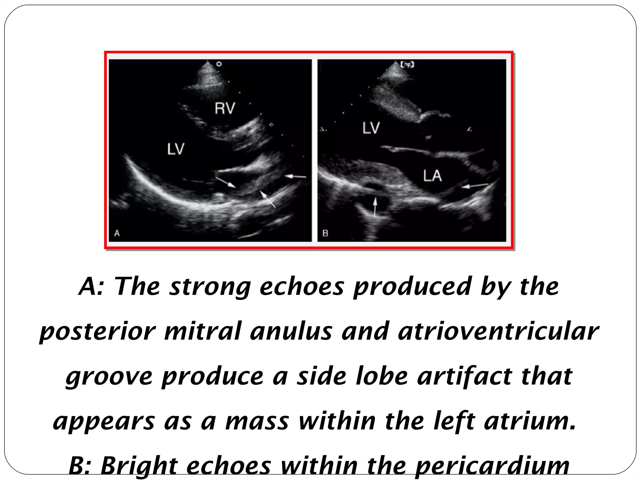 A: The strong echoes produced by the
posterior mitral anulus and atrioventricular
groove produce a side lobe artifact that
appears as a mass within the left atrium.
B: Bright echoes within the pericardium
 