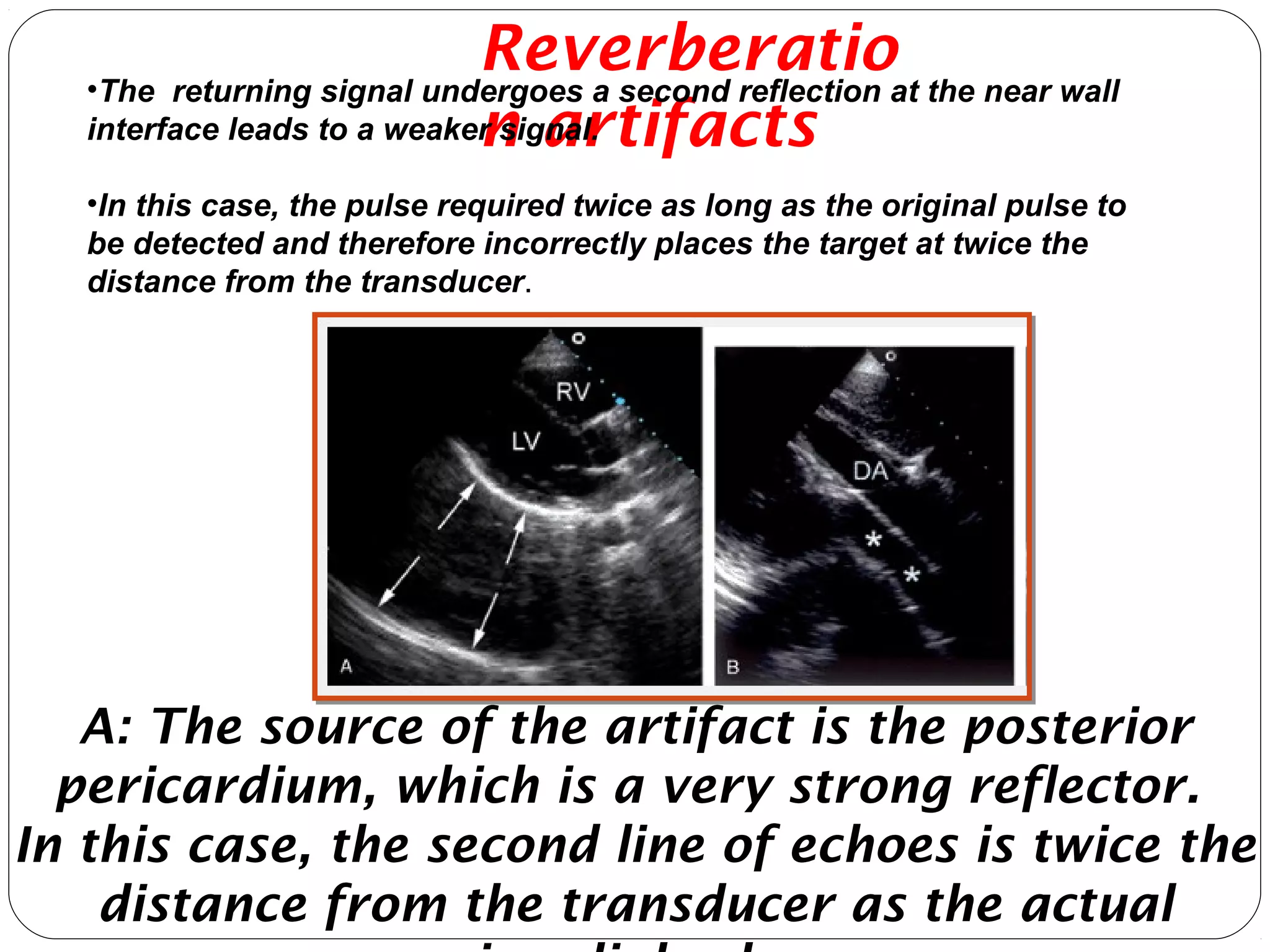 A: The source of the artifact is the posterior
pericardium, which is a very strong reflector.
In this case, the second line of echoes is twice the
distance from the transducer as the actual
Reverberatio
n artifacts
•The returning signal undergoes a second reflection at the near wall
interface leads to a weaker signal.
•In this case, the pulse required twice as long as the original pulse to
be detected and therefore incorrectly places the target at twice the
distance from the transducer.
 