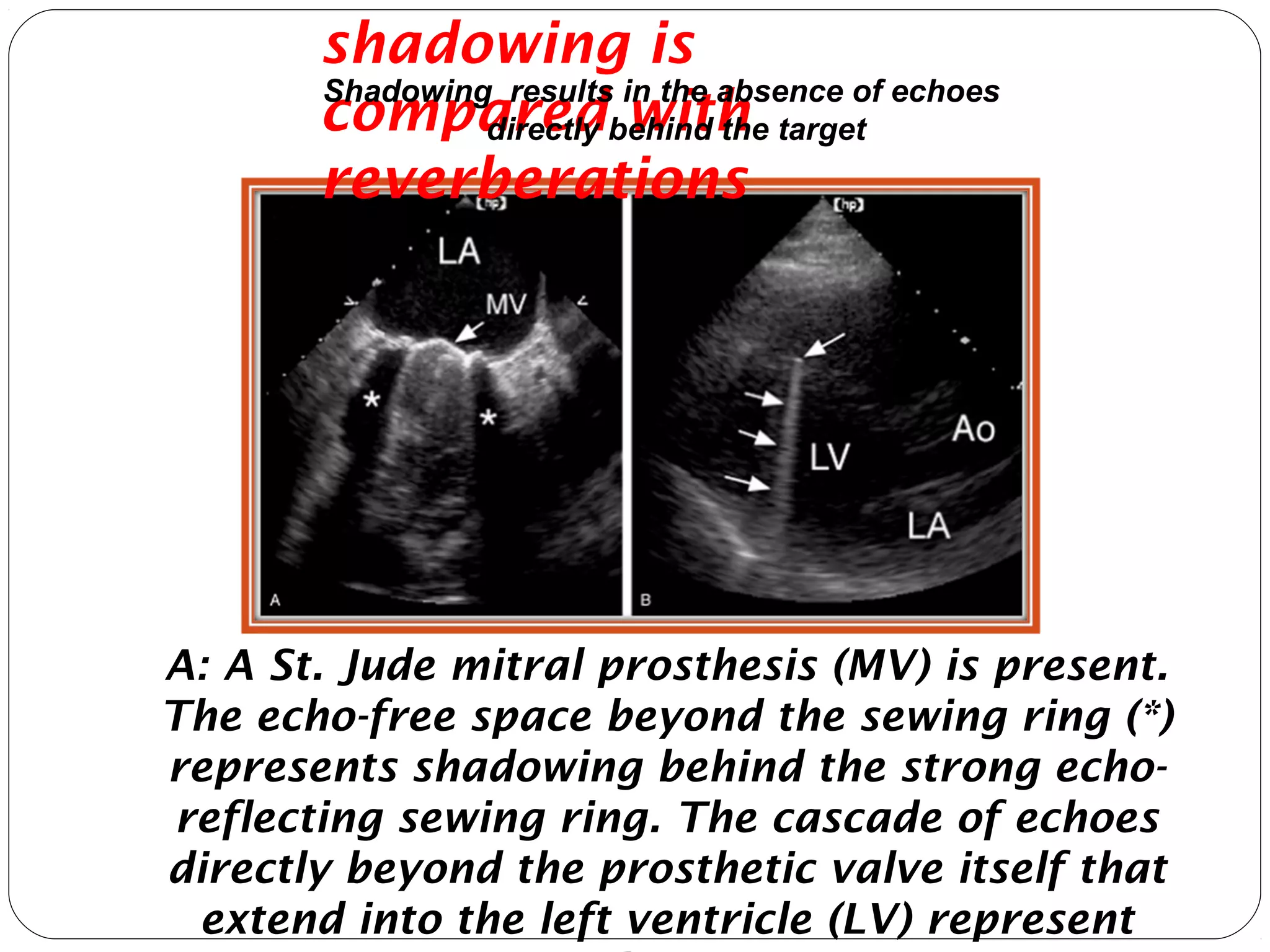 A: A St. Jude mitral prosthesis (MV) is present.
The echo-free space beyond the sewing ring (*)
represents shadowing behind the strong echo-
reflecting sewing ring. The cascade of echoes
directly beyond the prosthetic valve itself that
extend into the left ventricle (LV) represent
shadowing is
compared with
reverberations
Shadowing results in the absence of echoes
directly behind the target
 