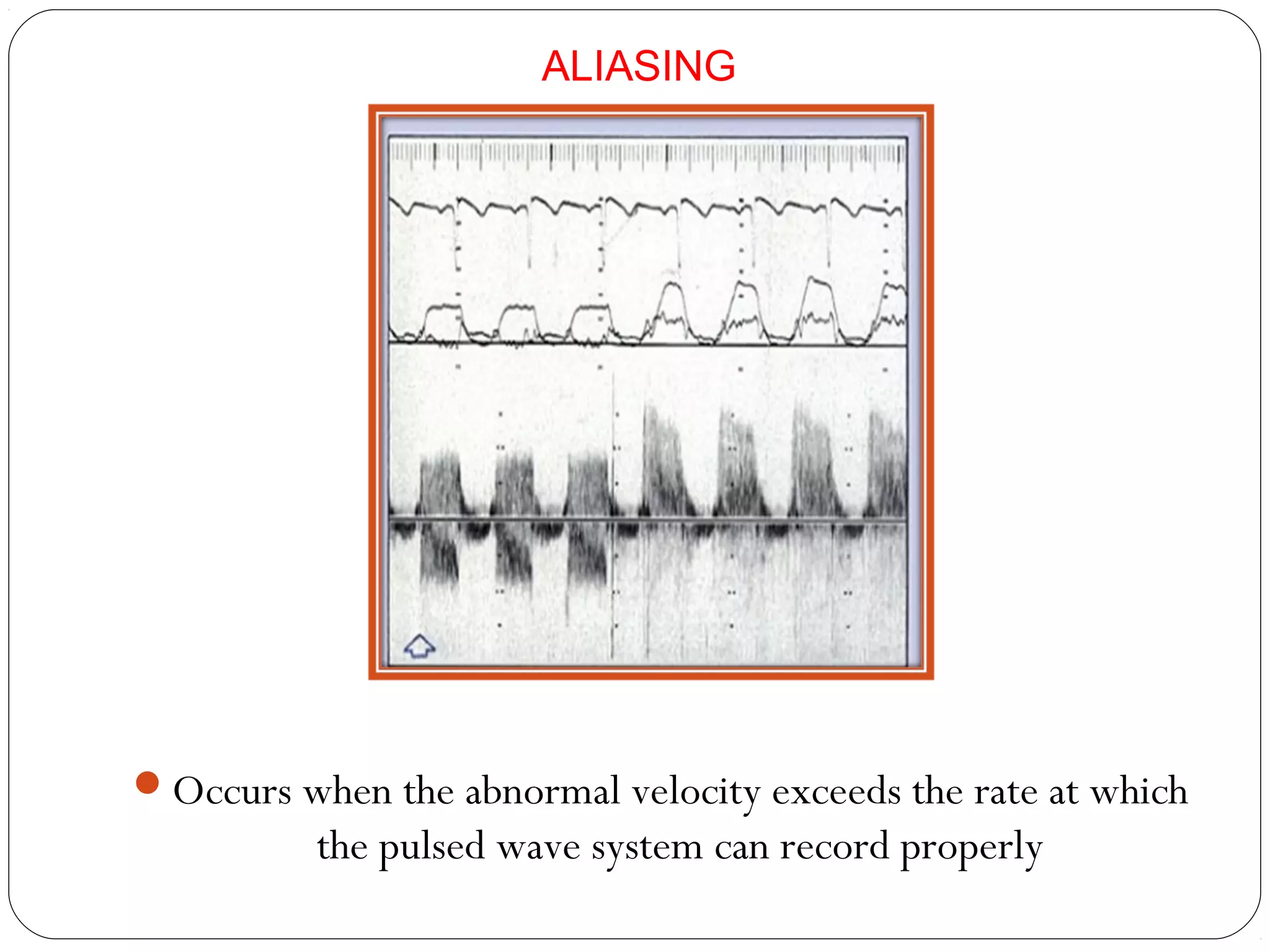 Occurs when the abnormal velocity exceeds the rate at which
the pulsed wave system can record properly
ALIASING
 