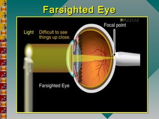 Farsighted EyeFarsighted Eye
 
