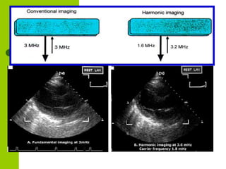Physics of ultrasound and echocardiography