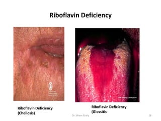 Riboflavin Deficiency




Riboflavin Deficiency                        Riboflavin Deficiency
(Cheilosis)                                  (Glossitis
                          Dr. Siham Gritly                           28
 