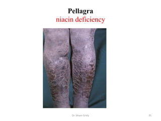 Pellagra
niacin deficiency




     Dr. Siham Gritly   35
 