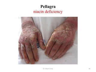 Pellagra
niacin deficiency




     Dr. Siham Gritly   36
 