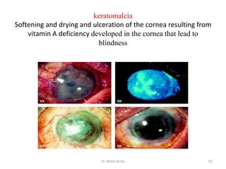 keratomalcia
Softening and drying and ulceration of the cornea resulting from
    vitamin A deficiency developed in the cornea that lead to
                           blindness




                            Dr. Siham Gritly                   82
 