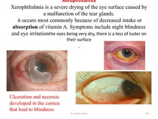 Xerophthalmia
Xerophthalmia is a severe drying of the eye surface caused by
                a malfunction of the tear glands.
  it occurs most commonly because of decreased intake or
absorption of vitamin A. Symptoms include night blindness
and eye irritationthe eyes being very dry, there is a loss of luster on
                             their surface
                                      .




Ulceration and necrosis
developed in the cornea
that lead to blindness
                               Dr. Siham Gritly                       83
 