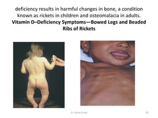 deficiency results in harmful changes in bone, a condition
  known as rickets in children and osteomalacia in adults.
Vitamin D–Deficiency Symptoms—Bowed Legs and Beaded
                        Ribs of Rickets




                         Dr. Siham Gritly                 93
 