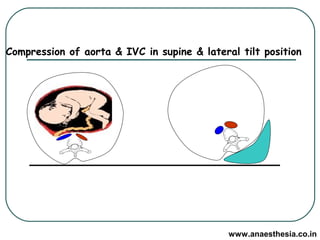 Compression of aorta & IVC in supine & lateral tilt position

www.anaesthesia.co.in

 