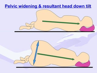 Pelvic widening & resultant head down tilt

 