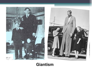 Giantism 