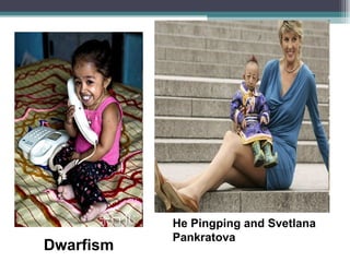 Dwarfism He Pingping and Svetlana Pankratova 