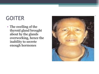 GOITER  The swelling of the thyroid gland brought about by the glands overworking, hence the inability to secrete enough hormones 
