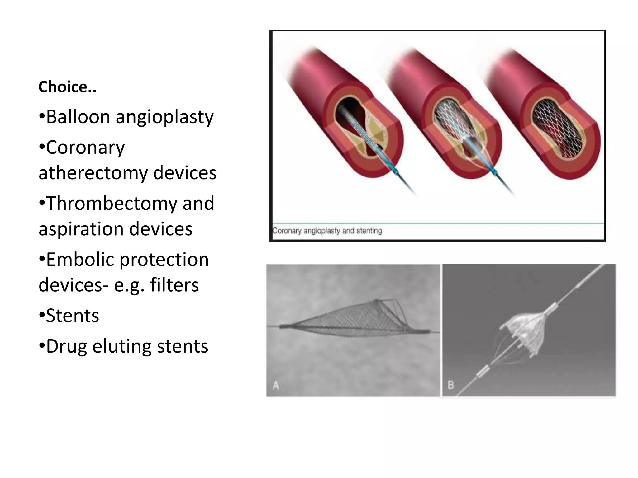 Choice..
•Balloon angioplasty
•Coronary
atherectomy devices
•Thrombectomy and
aspiration devices
•Embolic protection
devices- e.g. filters
•Stents
•Drug eluting stents
 