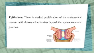 Epithelium: There is marked proliferation of the endocervical
mucosa with downward extension beyond the squamocolumnar
junction.
 