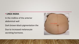  LINEA NIGRA
In the midline of the anterior
abdominal wall
Dark brown-black pigmentation the
Due to increased melanocyte
secreting hormone.
 