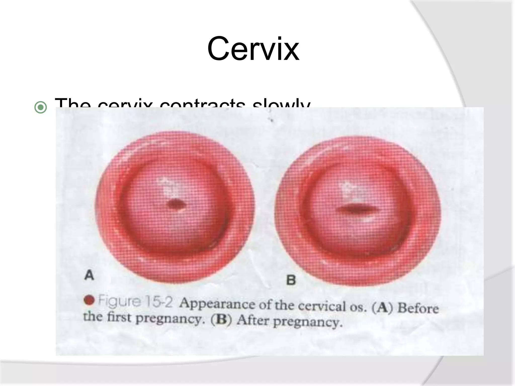 Cervix
 The cervix contracts slowly.
 External os: admits two fingers for a few days
but by the end of first week, narrow down to
admit the tip of finger only. It never returns back
to the nulliparous state, usually remains slightly
open and appear slitlike or stellate (star shaped).
 Internal os: Internal os closes as before.
 
