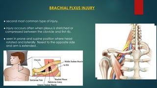 BRACHIAL PLXUS INJURY
● second most common type of injury.
● injury occours often when plexus is stretched or
compressed between the clavicle and first rib.
● seen in prone and supine position where head
rotated and laterally flexed to the opposite side
and arm is extended .
 