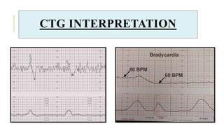 CTG INTERPRETATION
 