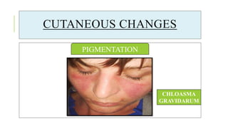CUTANEOUS CHANGES
PIGMENTATION
CHLOASMA
GRAVIDARUM
 