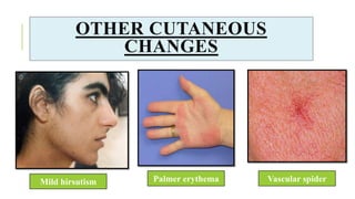 OTHER CUTANEOUS
CHANGES
Palmer erythema Vascular spider
Mild hirsutism
 
