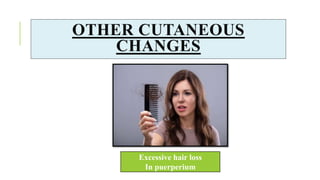 Excessive hair loss
In puerperium
OTHER CUTANEOUS
CHANGES
 