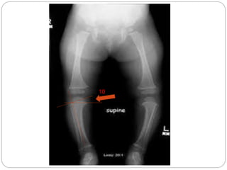 Physiological & pathological tibia vara | PPT