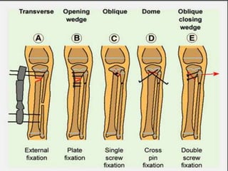 Physiological & pathological tibia vara | PPT
