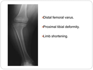 Physiological & pathological tibia vara | PPT