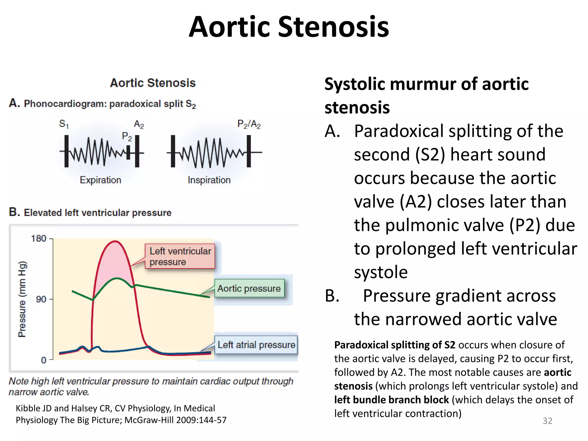 Aortic Stenosis
Systolic murmur of aortic
stenosis
A. Paradoxical splitting of the
second (S2) heart sound
occurs because the aortic
valve (A2) closes later than
the pulmonic valve (P2) due
to prolonged left ventricular
systole
B. Pressure gradient across
the narrowed aortic valve

Kibble JD and Halsey CR, CV Physiology, In Medical
Physiology The Big Picture; McGraw-Hill 2009:144-57

Paradoxical splitting of S2 occurs when closure of
the aortic valve is delayed, causing P2 to occur first,
followed by A2. The most notable causes are aortic
stenosis (which prolongs left ventricular systole) and
left bundle branch block (which delays the onset of
left ventricular contraction)
32

 