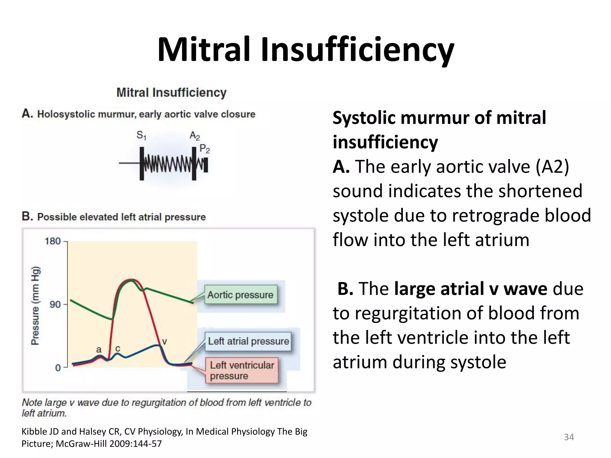 Mitral Insufficiency
Systolic murmur of mitral
insufficiency
A. The early aortic valve (A2)
sound indicates the shortened
systole due to retrograde blood
flow into the left atrium
B. The large atrial v wave due
to regurgitation of blood from
the left ventricle into the left
atrium during systole

Kibble JD and Halsey CR, CV Physiology, In Medical Physiology The Big
Picture; McGraw-Hill 2009:144-57

34

 