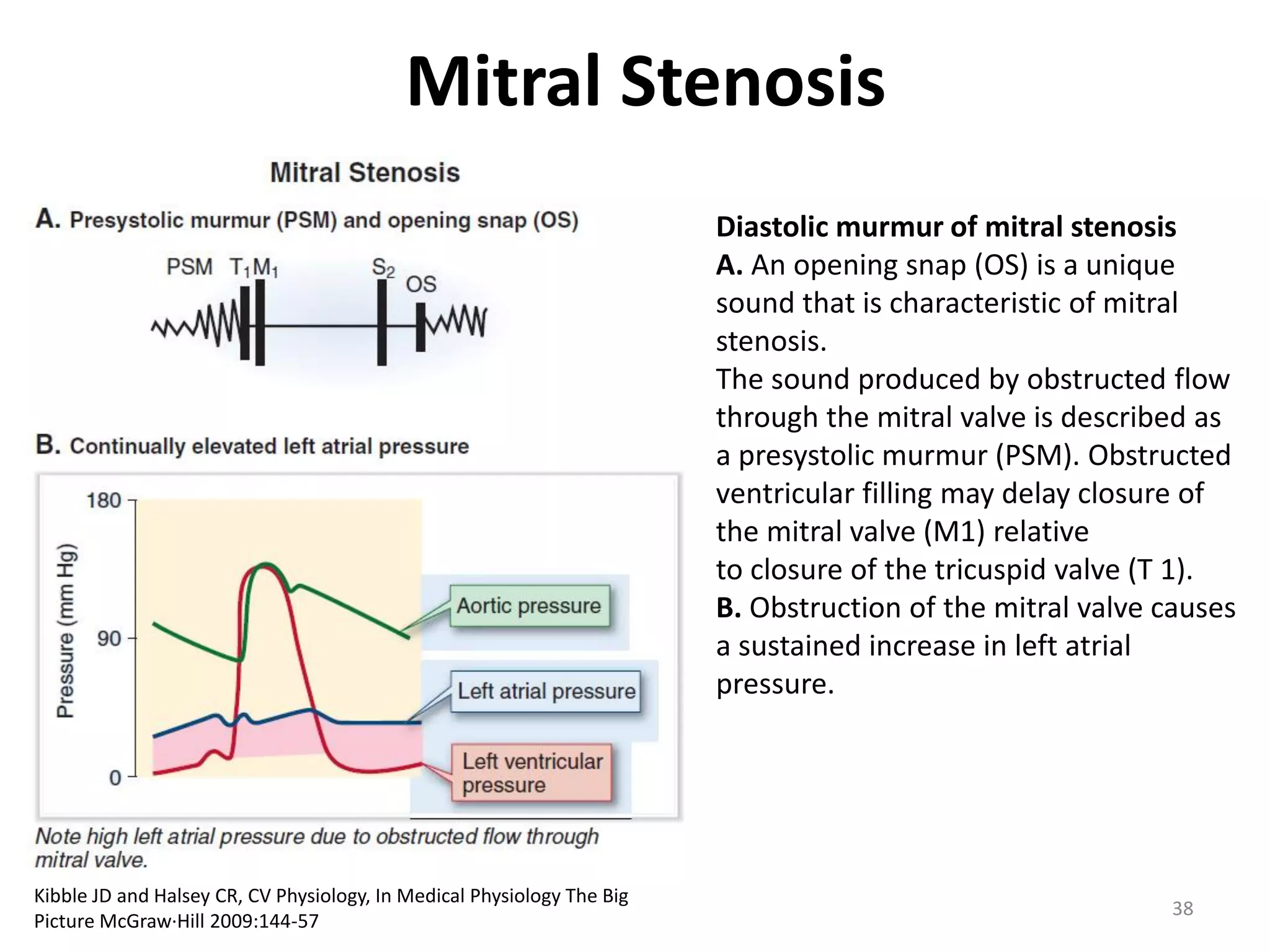 Mitral Stenosis
Diastolic murmur of mitral stenosis
A. An opening snap (OS) is a unique
sound that is characteristic of mitral
stenosis.
The sound produced by obstructed flow
through the mitral valve is described as
a presystolic murmur (PSM). Obstructed
ventricular filling may delay closure of
the mitral valve (M1) relative
to closure of the tricuspid valve (T 1).
B. Obstruction of the mitral valve causes
a sustained increase in left atrial
pressure.

Kibble JD and Halsey CR, CV Physiology, In Medical Physiology The Big
Picture McGraw·Hill 2009:144-57

38

 
