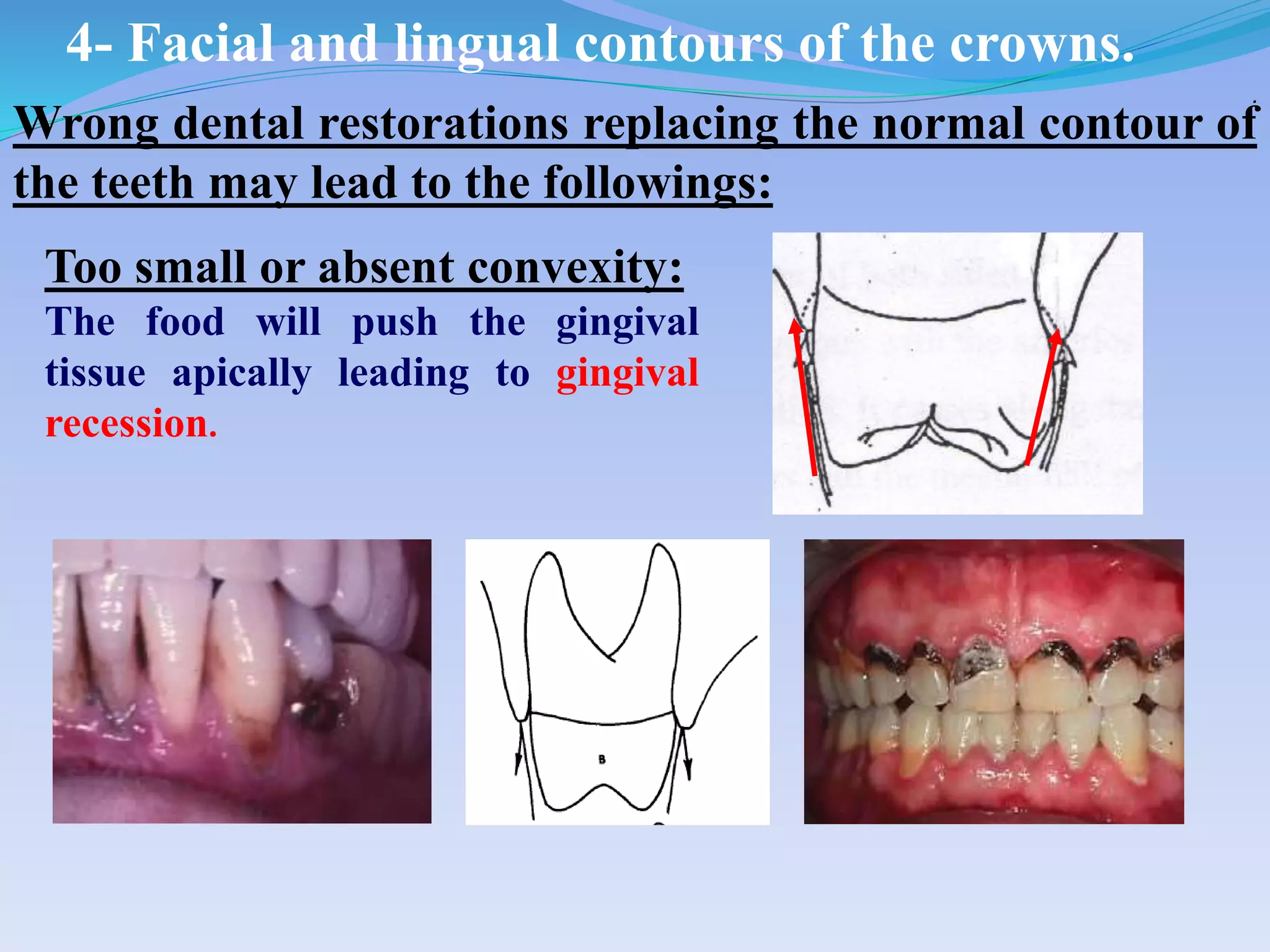 Too small or absent convexity:
The food will push the gingival
tissue apically leading to gingival
recession.
.
Wrong dental restorations replacing the normal contour of
the teeth may lead to the followings:
4- Facial and lingual contours of the crowns.
 