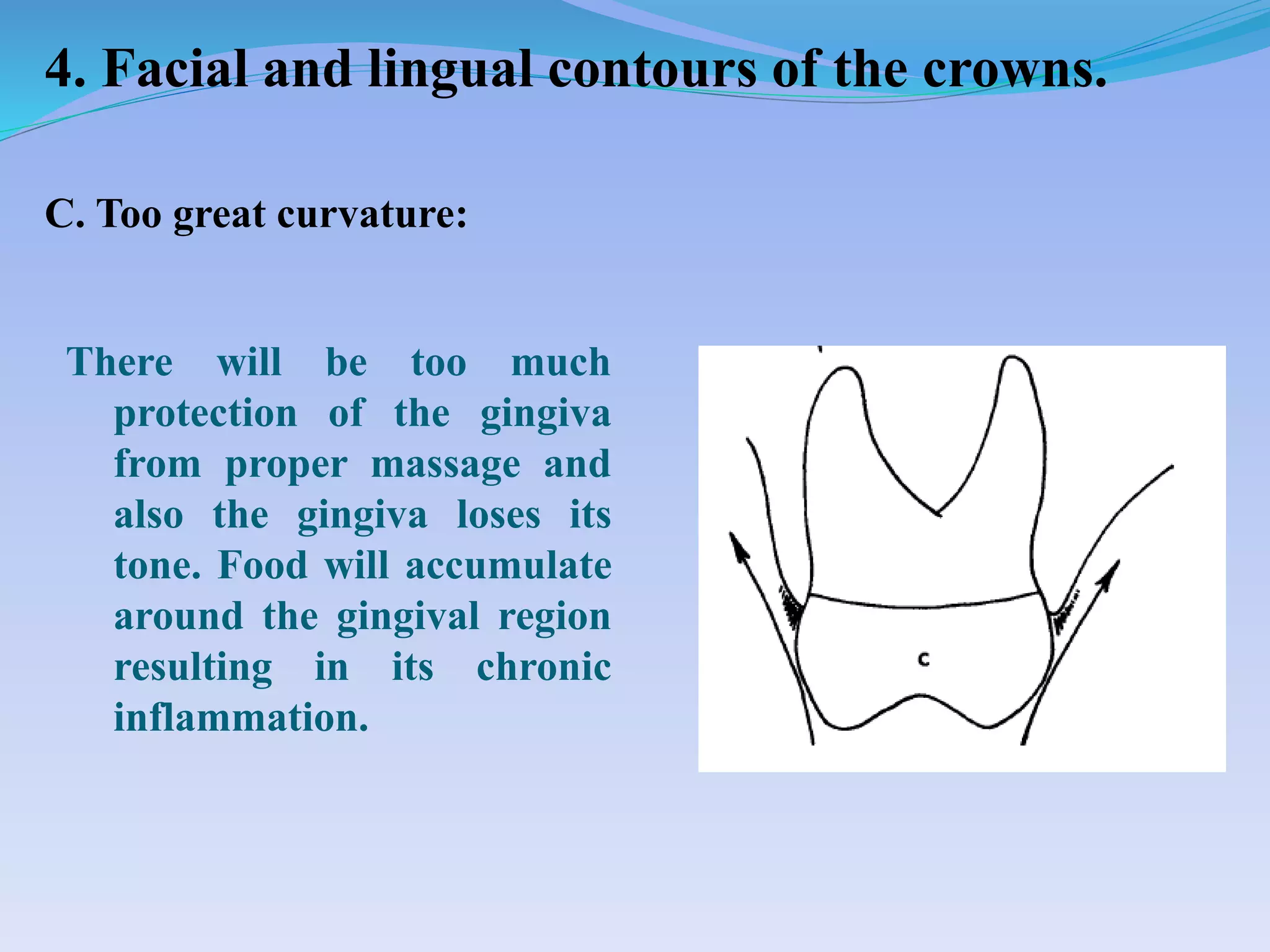 4. Facial and lingual contours of the crowns.
There will be too much
protection of the gingiva
from proper massage and
also the gingiva loses its
tone. Food will accumulate
around the gingival region
resulting in its chronic
inflammation.
C. Too great curvature:
 