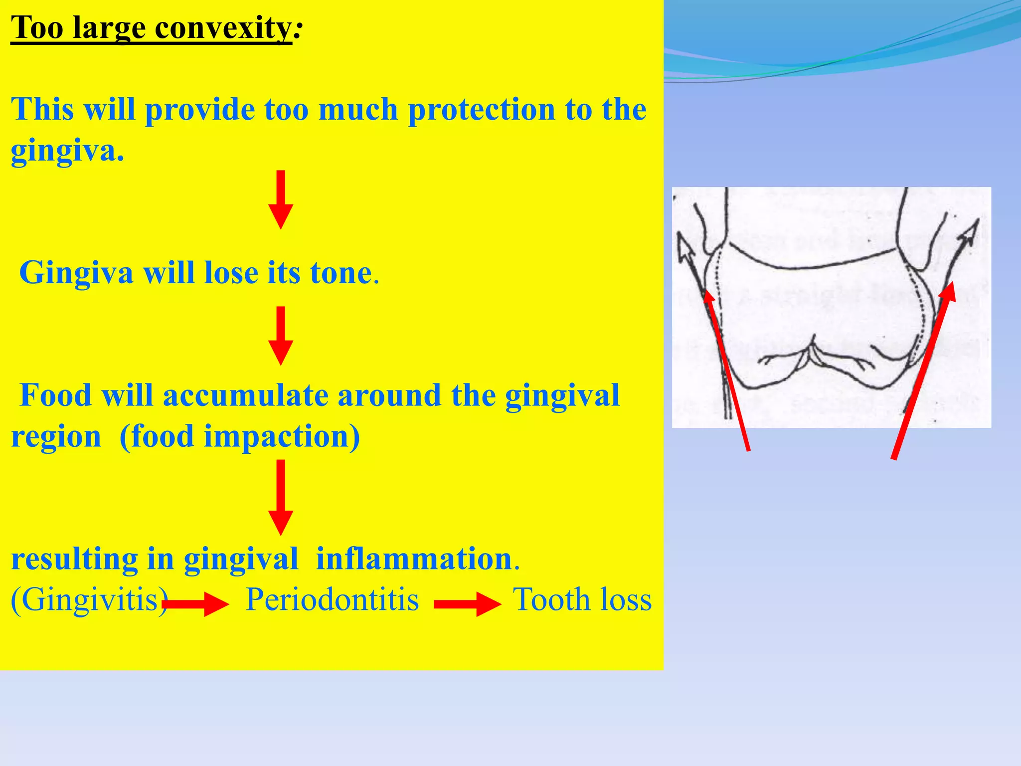 Too large convexity:
This will provide too much protection to the
gingiva.
Gingiva will lose its tone.
Food will accumulate around the gingival
region (food impaction)
resulting in gingival inflammation.
(Gingivitis) Periodontitis Tooth loss
 