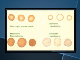 Normocytic Normochromic
Macrocytic
Normochromic
Microcytic
Hypochromic
Macrocytic
Hypochromic
 