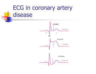 ECG in coronary artery
disease
 