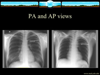 Physiology of Chest X-Ray | PPT