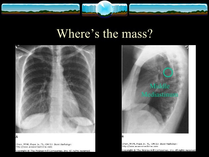 physiology of chest x ray chest xray
