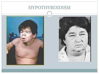 HYPOTHYROIDISM
 