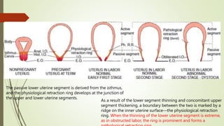 The passive lower uterine segment is derived from the isthmus,
and the physiological retraction ring develops at the junction of
the upper and lower uterine segments.
As a result of the lower segment thinning and concomitant upper
segment thickening, a boundary between the two is marked by a
ridge on the inner uterine surface—the physiological retraction
ring. When the thinning of the lower uterine segment is extreme,
as in obstructed labor, the ring is prominent and forms a
 