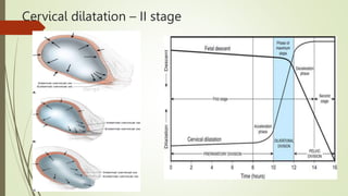 Cervical dilatation – II stage
 