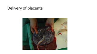 Delivery of placenta
 