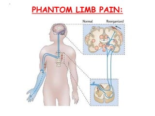 Phantom Rib Pain Physiology of pain2003 | PPT