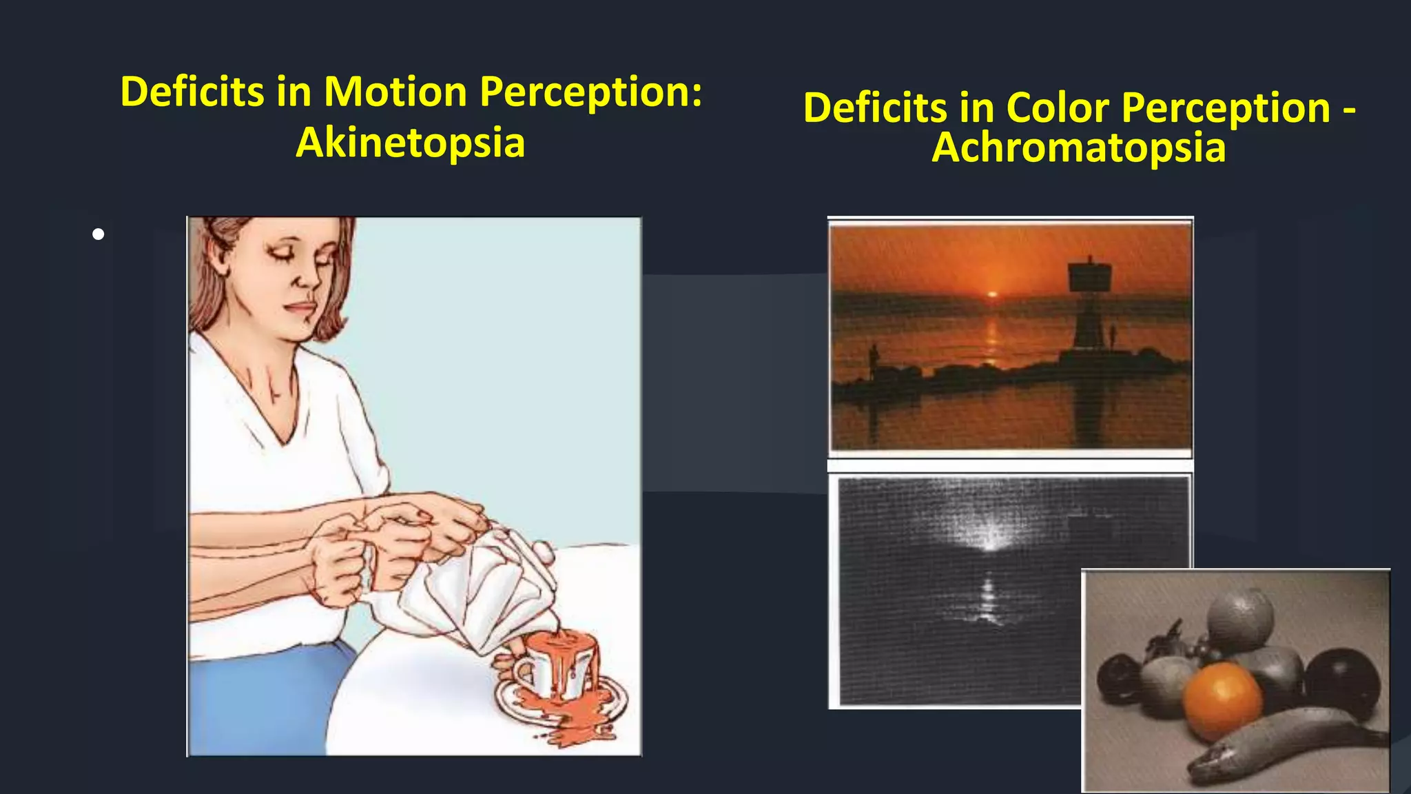 Deficits in Motion Perception:
Akinetopsia
•
36
Deficits in Color Perception -
Achromatopsia
 