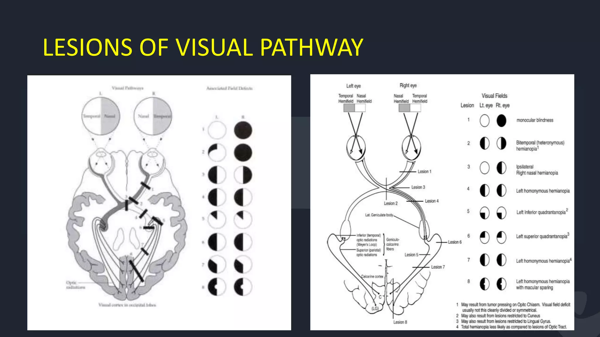 LESIONS OF VISUAL PATHWAY
59
 