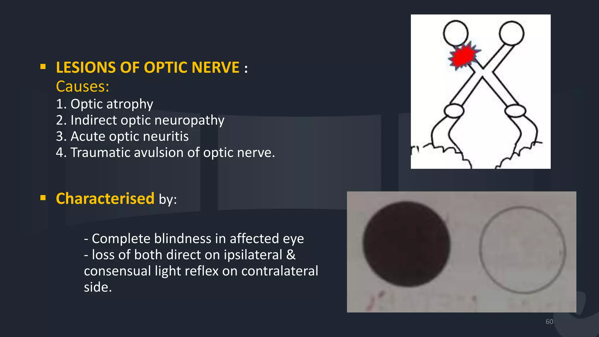  LESIONS OF OPTIC NERVE :
Causes:
1. Optic atrophy
2. Indirect optic neuropathy
3. Acute optic neuritis
4. Traumatic avulsion of optic nerve.
 Characterised by:
- Complete blindness in affected eye
- loss of both direct on ipsilateral &
consensual light reflex on contralateral
side.
60
 