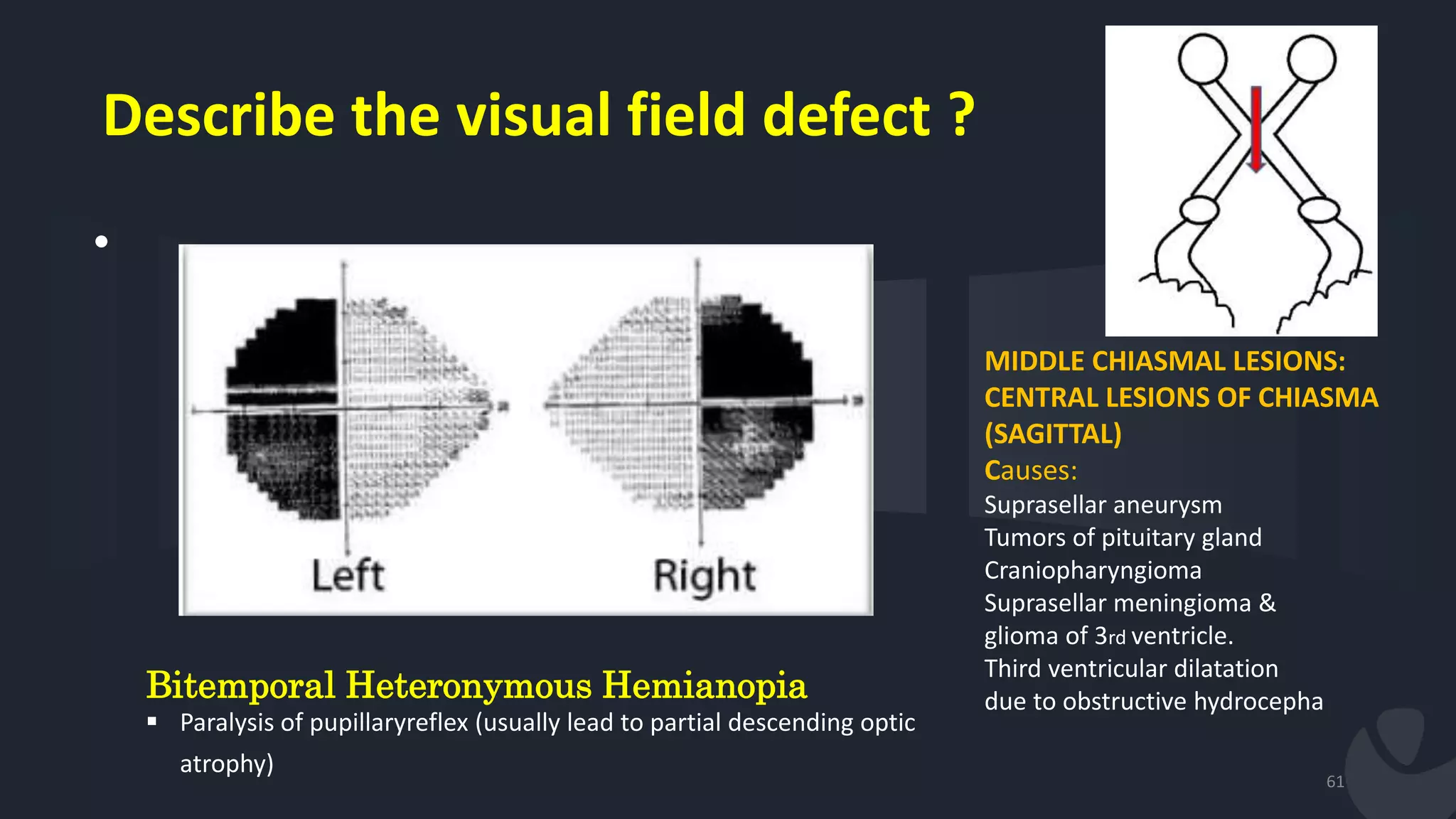 Describe the visual field defect ?
•
61
Bitemporal Heteronymous Hemianopia
 Paralysis of pupillaryreflex (usually lead to partial descending optic
atrophy)
MIDDLE CHIASMAL LESIONS:
CENTRAL LESIONS OF CHIASMA
(SAGITTAL)
Causes:
Suprasellar aneurysm
Tumors of pituitary gland
Craniopharyngioma
Suprasellar meningioma &
glioma of 3rd ventricle.
Third ventricular dilatation
due to obstructive hydrocepha
 