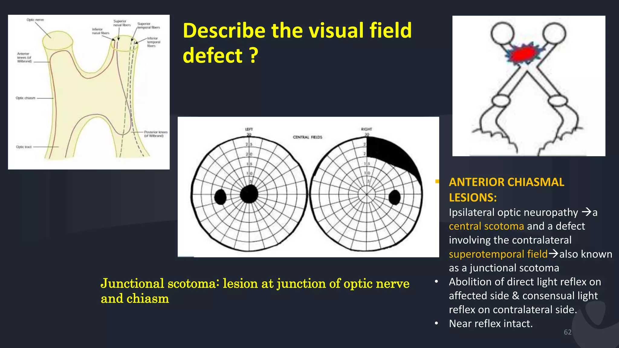 Describe the visual field
defect ?
•
62
Junctional scotoma: lesion at junction of optic nerve
and chiasm
 ANTERIOR CHIASMAL
LESIONS:
• Ipsilateral optic neuropathy a
central scotoma and a defect
involving the contralateral
superotemporal fieldalso known
as a junctional scotoma
• Abolition of direct light reflex on
affected side & consensual light
reflex on contralateral side.
• Near reflex intact.
 