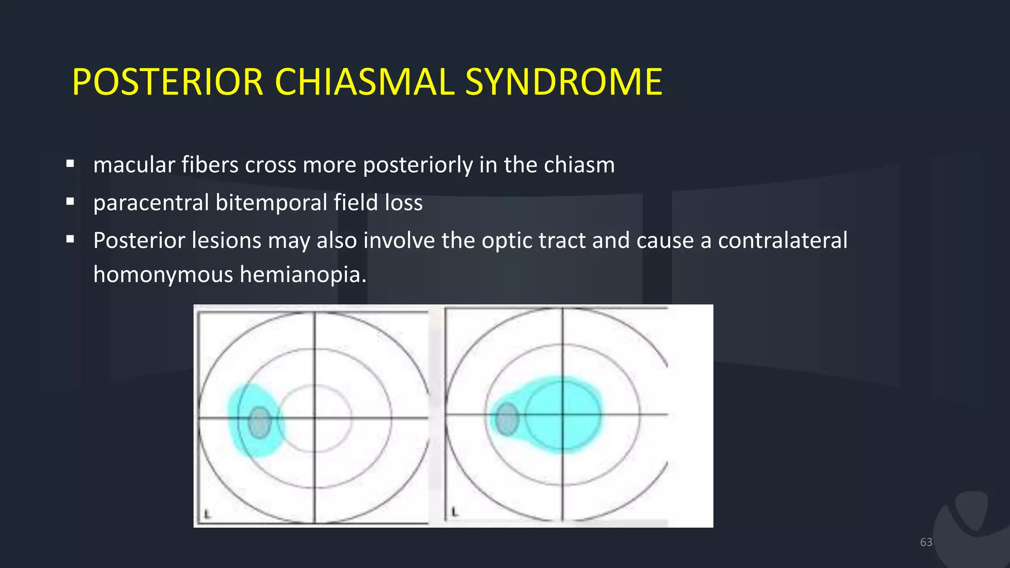 POSTERIOR CHIASMAL SYNDROME
 macular fibers cross more posteriorly in the chiasm
 paracentral bitemporal field loss
 Posterior lesions may also involve the optic tract and cause a contralateral
homonymous hemianopia.
63
 